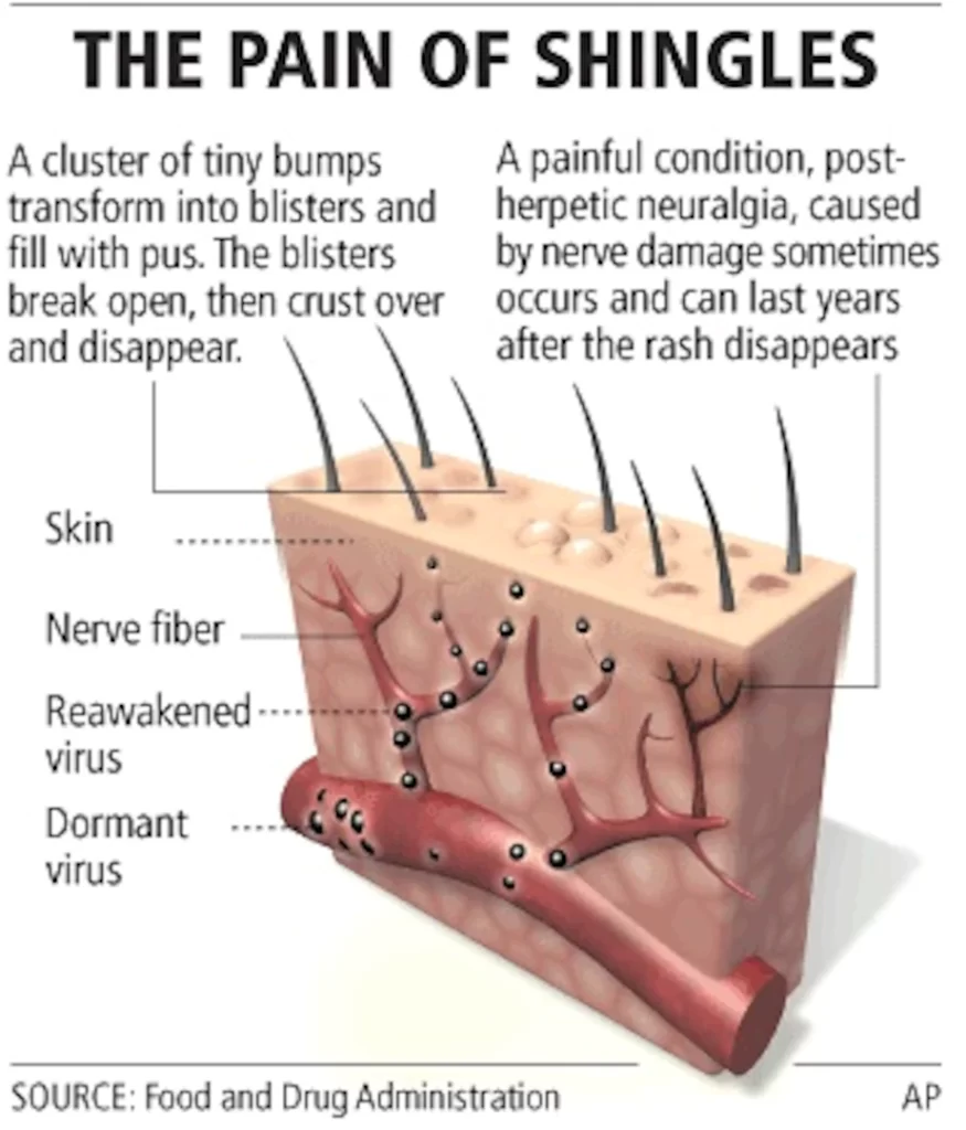 Shingles coos health wellness